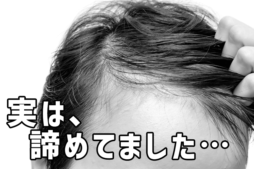 薄毛対策を諦める男性